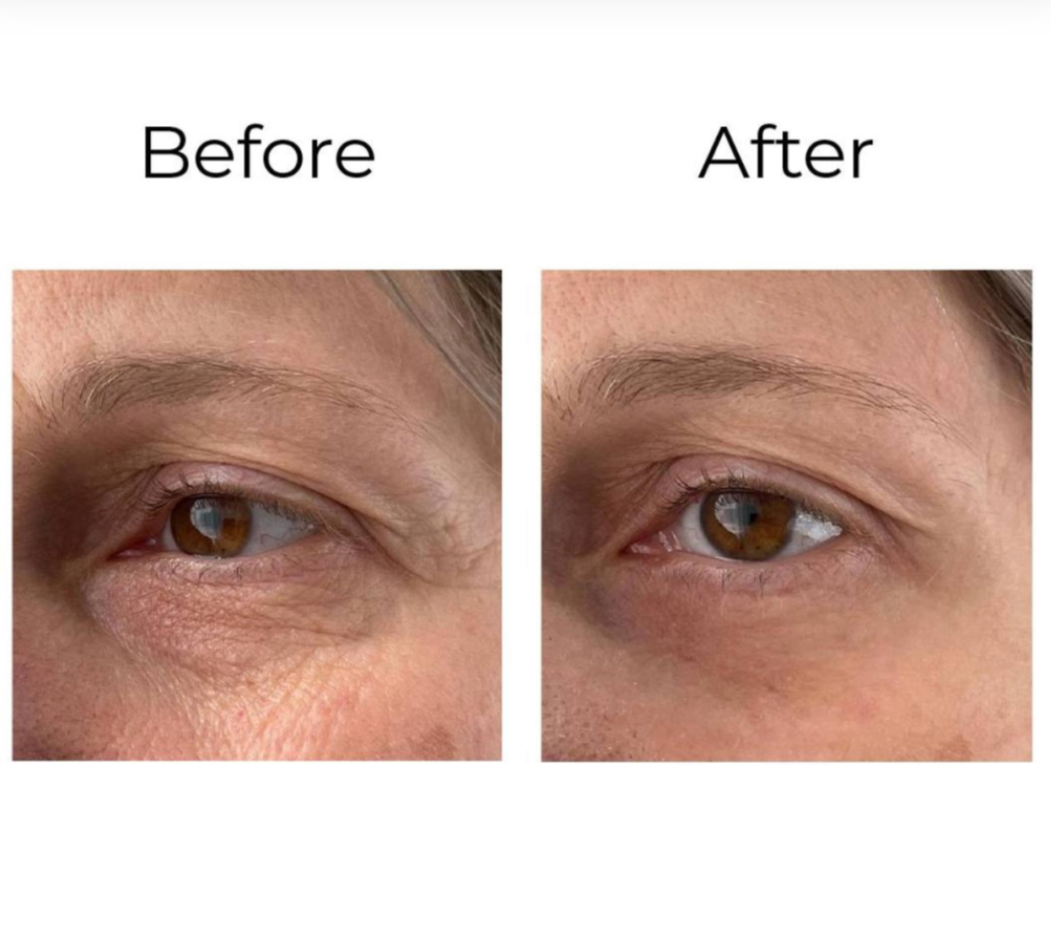 PEPTILUX – ANTI-FALTEN AUGENCREME „SHOCK ACTION"-EFFEKT MIT LIPHASYN™ #LUX001>