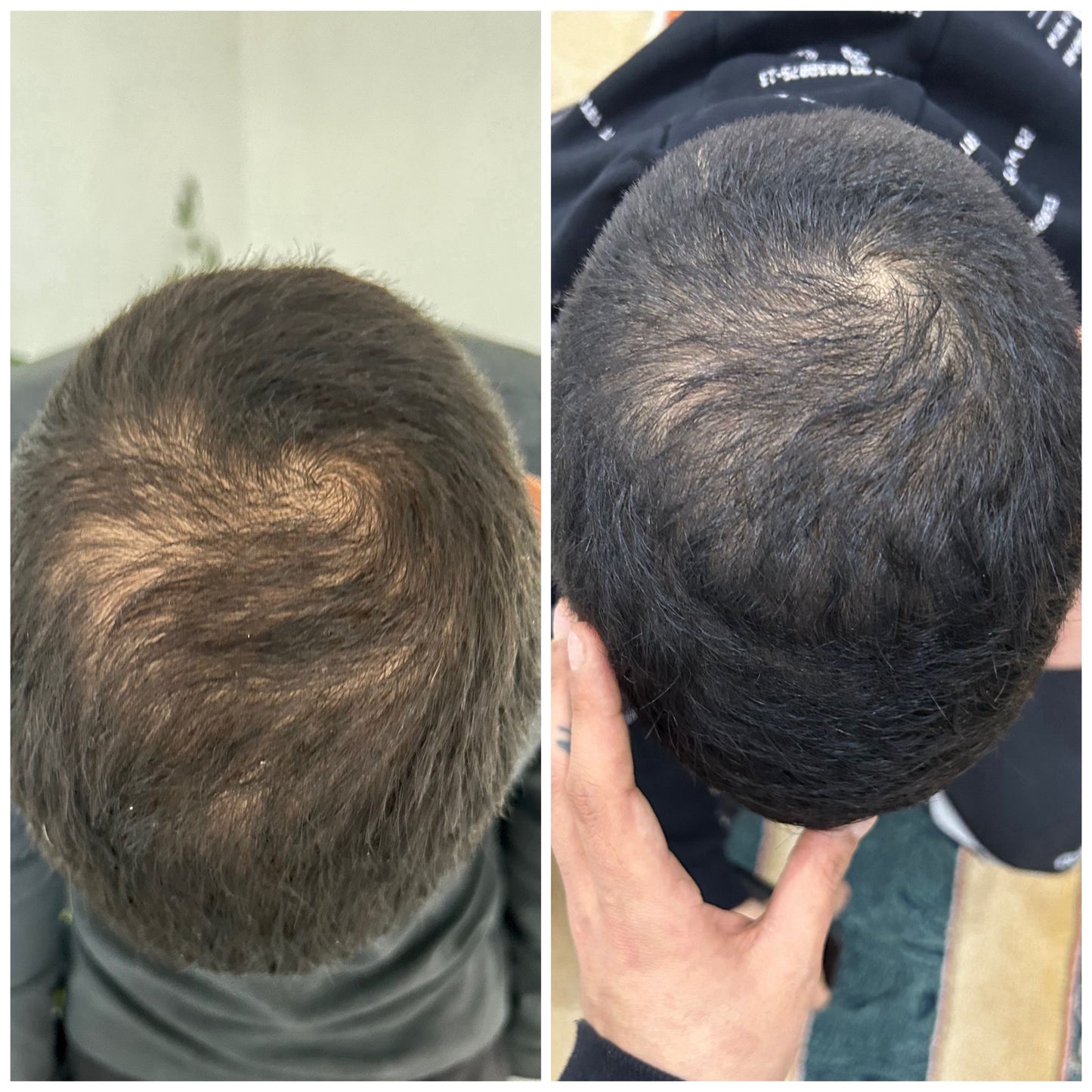 Anti-Haarverlust Lotion mit Undaria Pinnatifida 
Angereichert mit Arnika, Leberwurstbaum, Ginseng, Zimt, Salbei, Hafer & Seidenprotein #FA02B