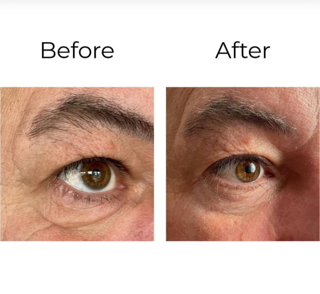 PEPTILUX – ANTI-FALTEN AUGENCREME „SHOCK ACTION&QUOT;-EFFEKT MIT LIPHASYN™  #LUX001>